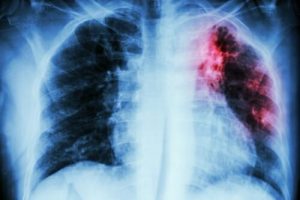 X-ray image of lungs with one damaged