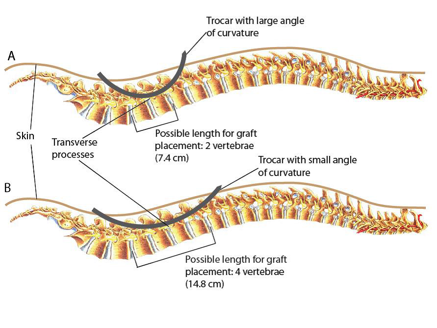 Figure 2. The placement of trocar along the spine.